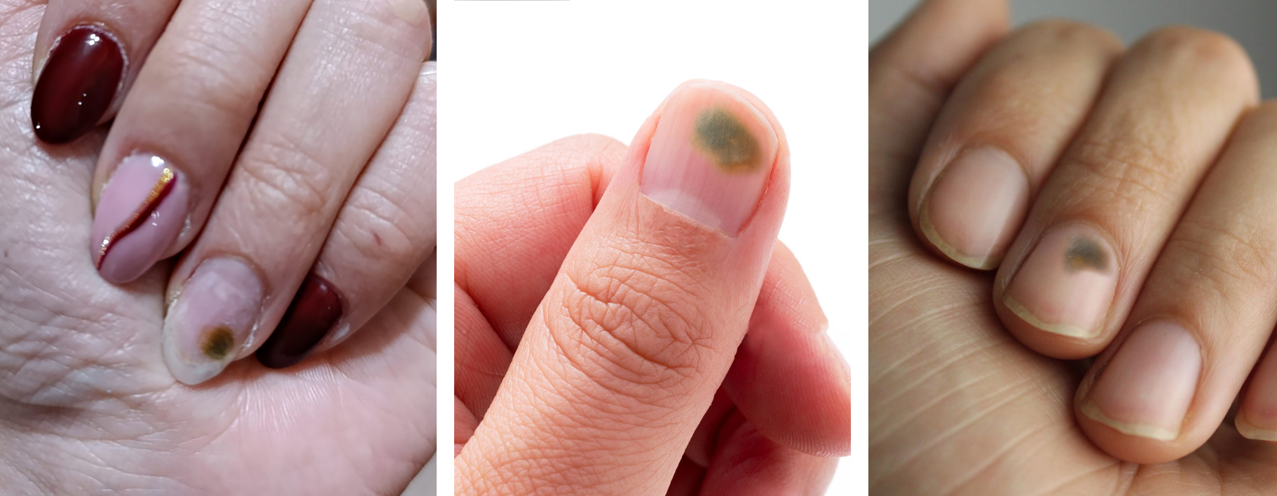 Zielona bakteria na paznokciu od czego?